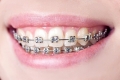 Phương pháp niềng răng mắc cài kim loại có khóa