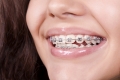 Giải đáp: Niềng răng mắc cài kim loại tự buộc là gì?