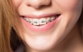 Phương pháp niềng răng mắc cài kim loại tự đóng
