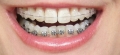 Có nên niềng răng không? Tác dụng của niềng răng là gì?