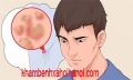 Liệu sùi mào gà có lây qua con đường ăn không ?