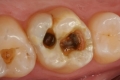 Nhổ răng sâu có ảnh hưởng gì không? Chuyên gia tư vấn