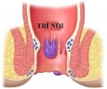 Những dấu hiệu và cách chữa trị bệnh trĩ nội độ 1