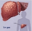 Xơ gan nguy hiểm như thế nào