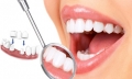 Giá bọc răng sứ thẩm mỹ rẻ nhất tại Hà Nội