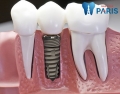 Chuyên gia giải đáp – Cấy ghép implant răng có đau không?