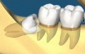 Chia sẻ quy trình nhổ răng khôn chuẩn và tốt nhất