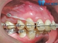 Sử dụng mini vit hỗ trợ niềng răng trong tình huống nào?