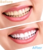 Có nên đi lấy cao răng thường xuyên không?
