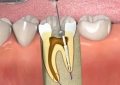 Quy trình lấy tủy răng đã qua kiểm định cho hiệu quả tốt nhất