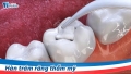 Địa chỉ hàn răng sâu ở Hà Nội tốt và uy tín nhất