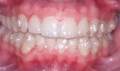 Niềng răng trong suốt có khả năng vượt trội như thế nào?