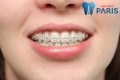 Thời gian và chi phí niềng 2 răng cửa được nha sĩ tiết lộ