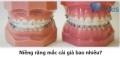 Nha sĩ chia sẻ địa chỉ niềng răng uy tín tại Hà Nội