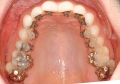 Nha sĩ tư vấn gì về phương pháp niềng răng mặt trong?
