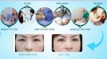 Tìm hiểu về quy trình bấm mí mắt Hàn Quốc