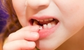 Cách nhổ răng sữa đúng đắn cho trẻ phát triển tốt nhất