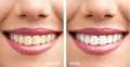 Tẩy trắng răng an toàn - Tạm biệt hàm răng ố vàng trong 30 phút!