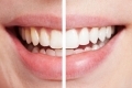 Chảy máu chân răng nên uống thuốc gì?