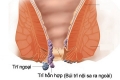 Bệnh trĩ hỗn hợp là như thế nào? Các hiện tượng của trĩ hỗn hợp
