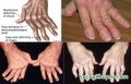 Bệnh viêm khớp dạng thấp và những điều cần biết