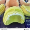 Các loại răng sứ thông dụng hiện nay