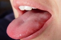 Cách điều trị bệnh sùi mào gà ở miệng