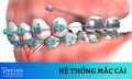 Niềng răng - Giải mã cấu tạo mắc cài và lựa chọn loại phù hợp