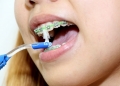 Những vật dụng hữu ích chăm sóc răng miệng khi niềng