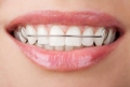 Những thông tin hữu ích về hàm duy trì sau khi niềng răng