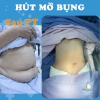 Địa chỉ hút mỡ bụng an toàn tại Đà Nẵng
