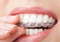 Các trường hợp phải niềng và kinh nghiệm niềng răng invisalign