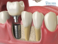 Hàm răng chắc khỏe, tự nhiên với trụ Implant Dentium Hàn Quốc