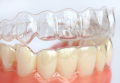 Niềng răng mắc cài - Tìm hiểu lợi ích của mắc cài cố định và mắc cài bi
