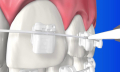 Niềng răng hiệu quả - Mắc cài kim loại 3M hay mắc cài sứ tự buộc 3M?