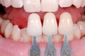 Nên niềng răng hay bọc sứ để có hiệu quả chỉnh nha tốt nhất?