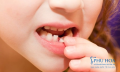 Khi nào nên nhổ răng sữa? Răng sữa bị sún, sâu