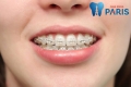 Quá trình niềng răng tiêu chuẩn cho hiệu quả chỉnh nha tốt nhất