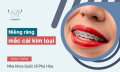 Niềng răng mắc cài kim loại - Hiệu quả và mức độ đau nhức