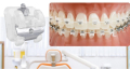 Lợi ích của việc sử dụng niềng răng mắc cài sứ