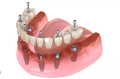 Khôi phục hàm răng hoàn hảo với Implant - Bắt vít chắc chắn, răng sứ thẩm mỹ