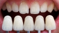 Những chia sẻ hữu ích của chuyên gia về bọc răng sứ