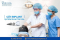 Trồng răng Implant là gì? Cấu tạo và ưu điểm vượt trội