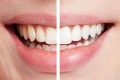 Tẩy trắng răng bằng công nghệ Plasma là gì?